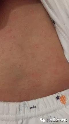 实例口述：新房装修，5岁儿子甲醛中毒！！！